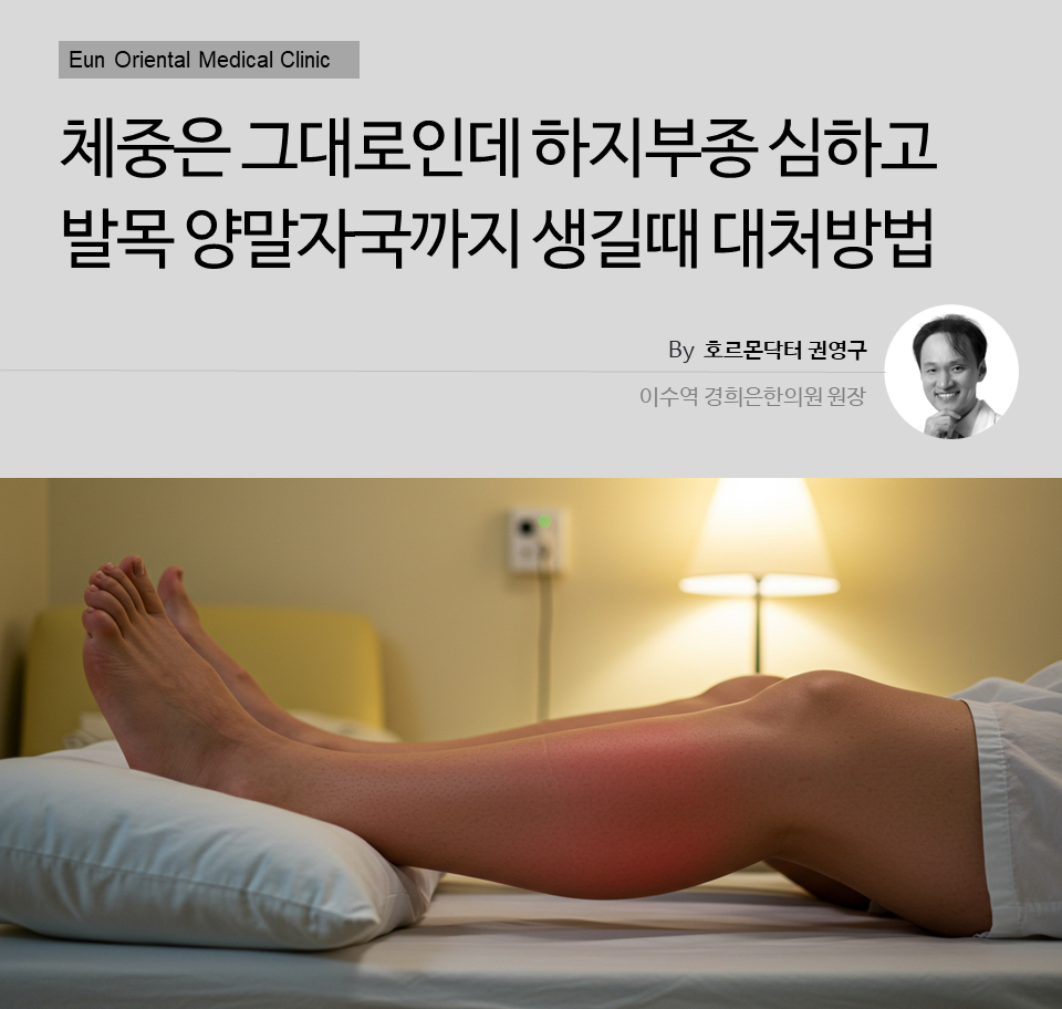 체중은 그대로인데 하지부종 심하고 발목 양말자국까지 생길때 대처방법